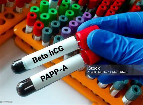 Infographic: Cum se combină PAPP-A, free beta-hCG și translucența nucleală în dublul test