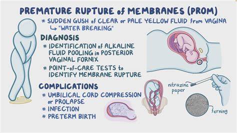 Infografic: fluxul diagnostic al rupterii premature a membrane