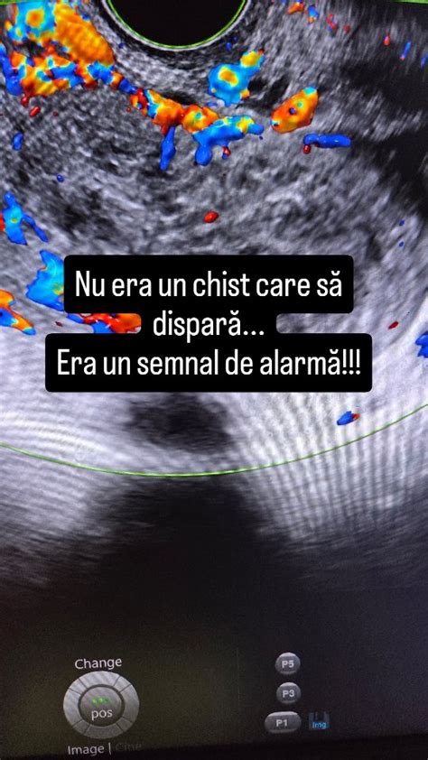 Imagine schemă placentară cu zone angiomatoase și vascularizație