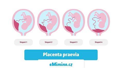 Infografic: tipuri de placenta praevia si management