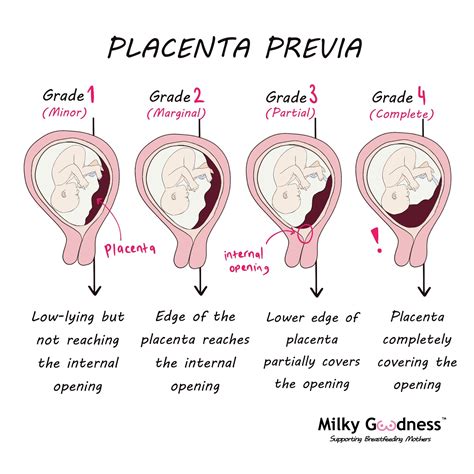 Grafic: clasificarea placenta praevia