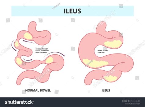 Infografic: tipuri de obstrucție intestinală la câini (ileus mecanic vs. ileus paralitic) și abordări diagnostice