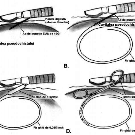 Pneumotorax - reprezentare schematică a aerului între foitele pleurale