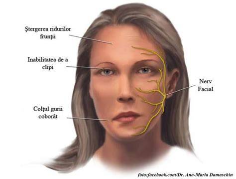 Schema gestionării îngrijirii oculare în pareza facială