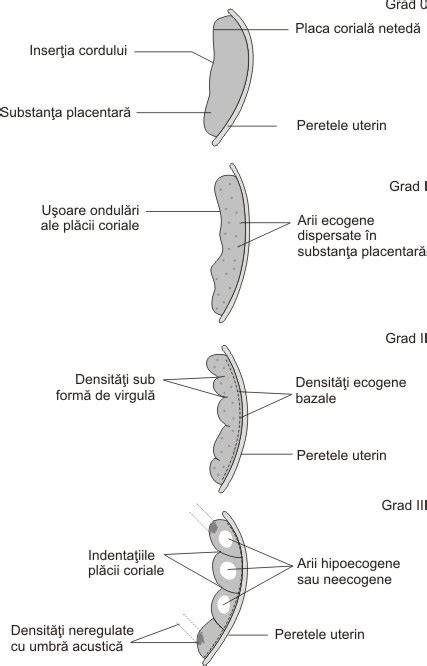 Diagrame: Găsirea ADN-ului HPV în placenta și lichidul amniotic