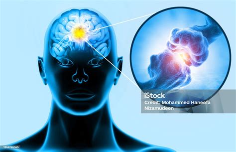 Ilustrație a creierului afectat de neurocisticercoză