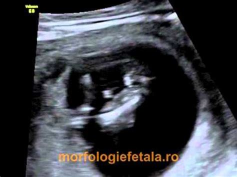 Harta mozaic a morfologiei fetal la trimestrul I