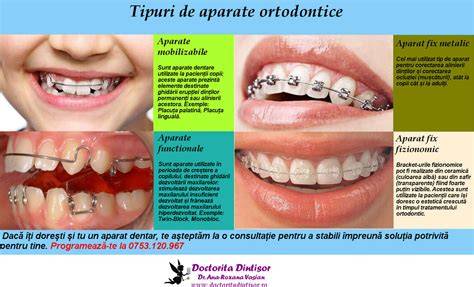 Infografic: Tipuri de aparate ortodontice pentru copii
