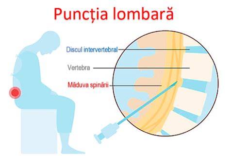 Diagramă: Poziționarea corectă a centurii lombare în timpul purtării