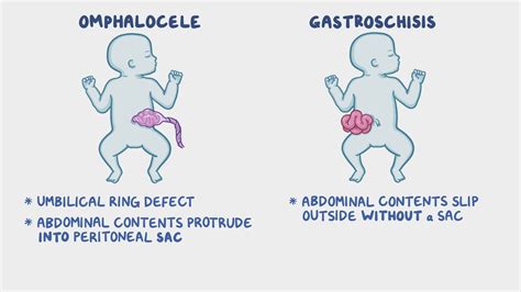 Infografic: Omfalocel vs gastroschizis - localizare, conținut și acoperire