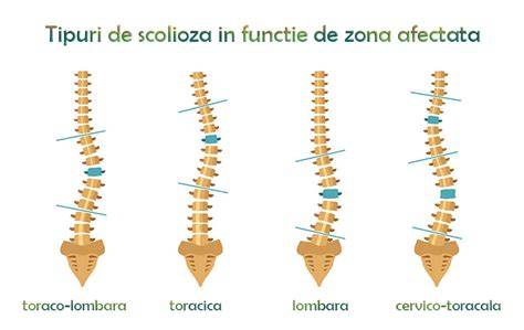 Diagramă a scheletului toracic afectat de scolioză