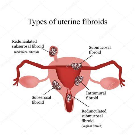 diagramă localizare fibroame uterine (submucoase, intramurale, subseroase)
