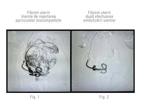 schemă procedură embolizare arteră uterină