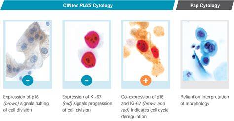 Infografic: fluxul screening-ului ginecologic (Babeș-Papanicolau, HPV, CINtec PLUS)