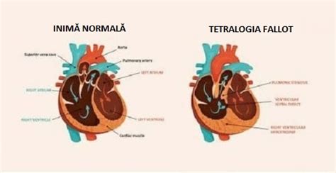 Grafic cu incidența bolilor cardiace congenitale la nou-născuți