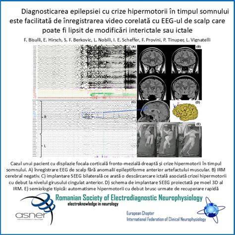 Infografic: Epilepsia la copii - manifestări și conduite după diagnosticul de neurologie pediatrică