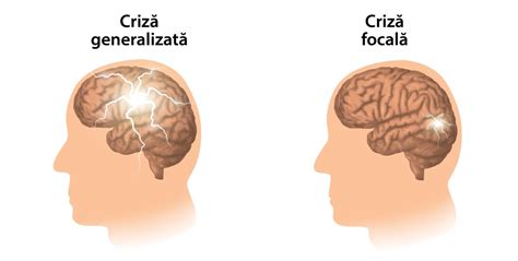 Ilustrație a unei crize convulsive în eclampsie