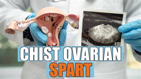 Chist ovarian gigant imagine