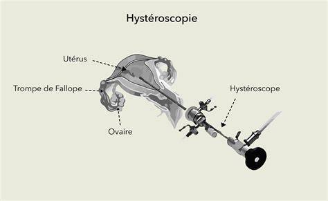 Histeroscopie - Schema interventiei