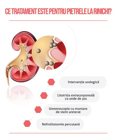 Diagramă a trăsurilor de tratament pentru pietrele la rinichi