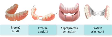 Tipuri de malocluzii dentare
