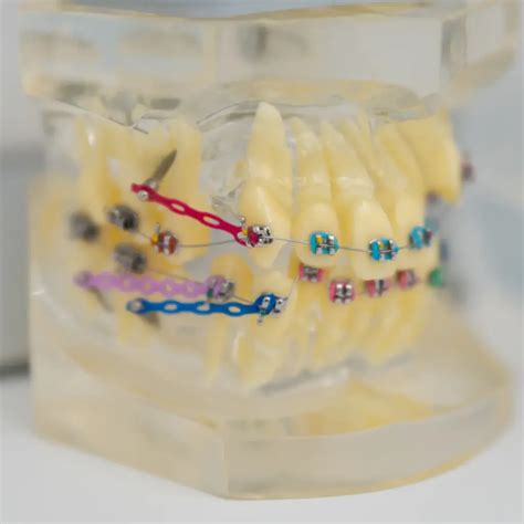 Aparat dentar pentru copii