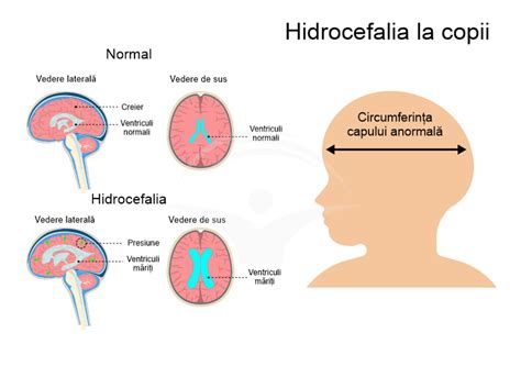 Infografic cu cauzele hidrocefaliei la copii