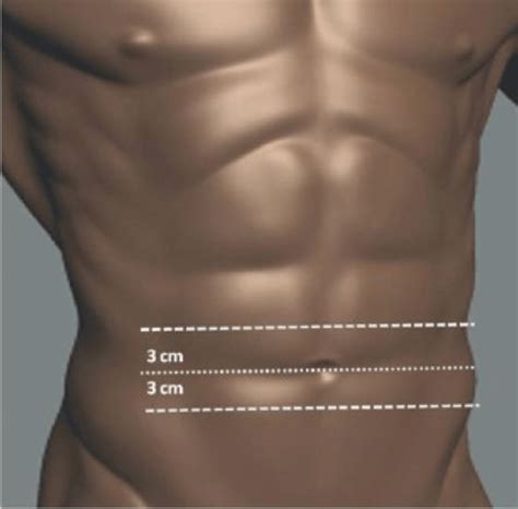 Ilustrație anatomică a herniei ombilicale