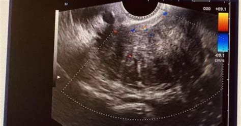 Ecografie transvaginală care arată un fibrom uterin