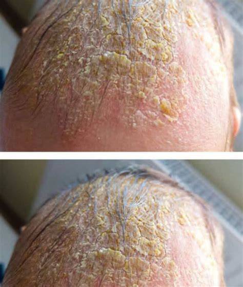 Imagine clinică: cruste galbene uleioase pe scalp