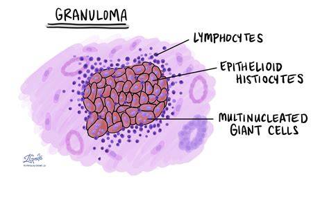 Diagramă: diferențiere granulom de fir vs. infecție postoperatorie