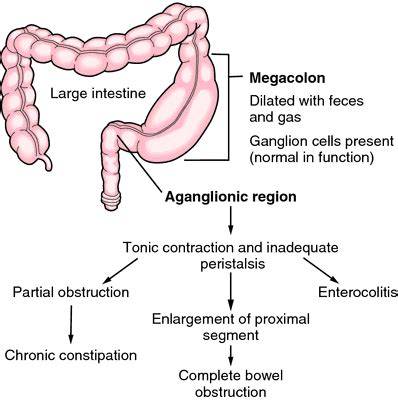 Infografic: Clasificare megacolon: acut Ogilvie, toxic, cronic, congenital
