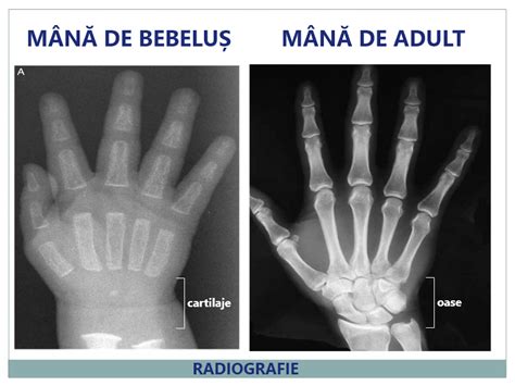 Radiografie toracică normală la copil