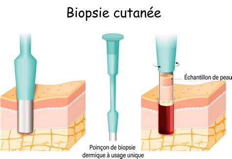 Schema diagnostic LNH: paşi de la anamneză la biopsie
