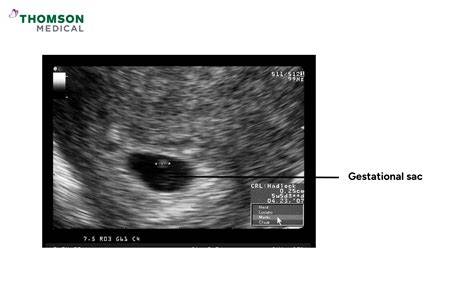 Sac gestational si potential gol - reprezentare grafica