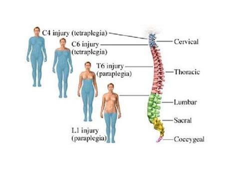 Poziții caracteristice ale membrelor în tetrapareza spastică