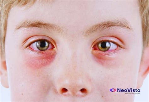 Microorganisme cauzatoare de conjunctivita