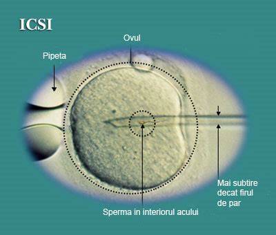 Procesul de inseminare intrauterina