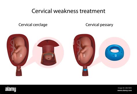 Imagine ilustrativă cu procedura de cerclaj cervical
