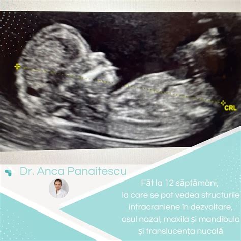 Ecografie fetală detaliată