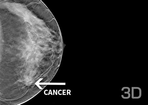 Mamografie digitală