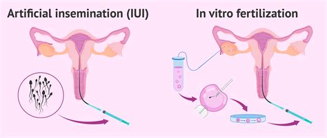 Infografic: Alegerea între IA, IUI, FIV, ICI și donatori de spermă