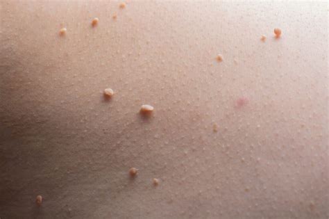 Grafic: Îmbolnăvirile cu veruci genitale înainte/după implementarea vaccinării în Australia