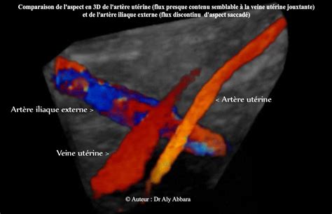 Diagrama artere uterine si Doppler