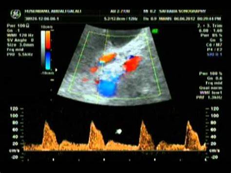 Diagramă flux Doppler în arterele uterine, ombilicală, MCA