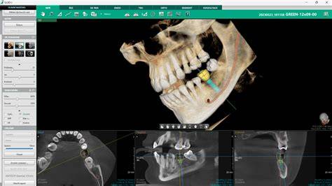 Infografic: etapele implantului dentar, de la planificare CBCT 3D la osteointegrare