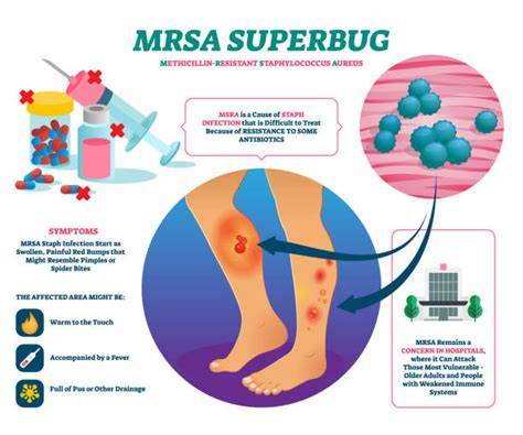 Diagel: Schema tratament MRSA versus stafilococi sensibili