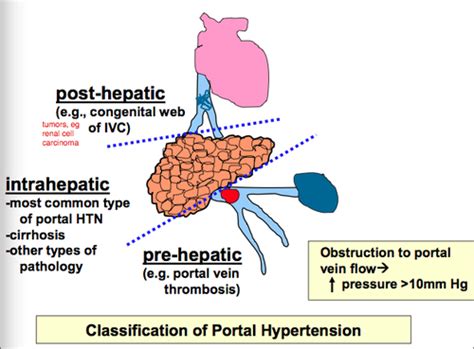 Infografic: mecanismele icterului (prehepatic, hepatic, posthepatic)